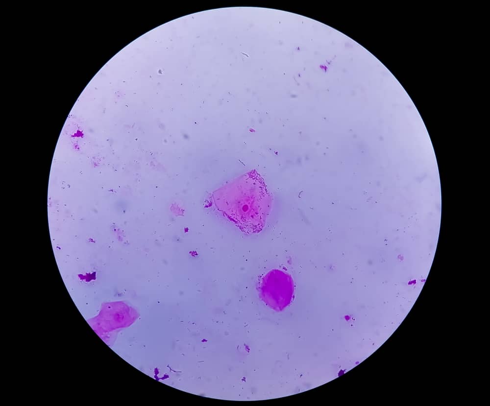 ý nghĩa đọc kết quả nhuộm soi