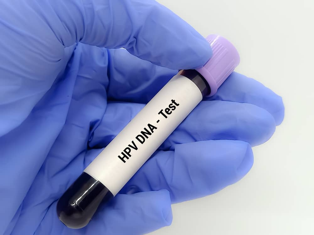 xét nghiệm HPV DNA