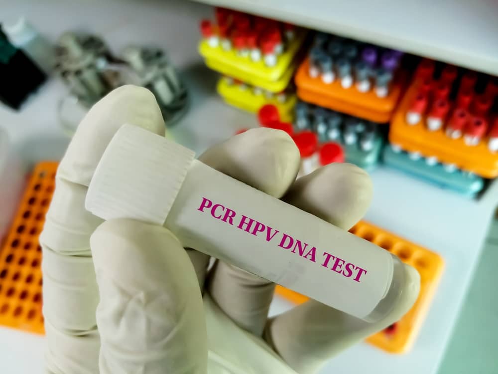 Xét nghiệm HPV nam giới bằng Real Time PCR