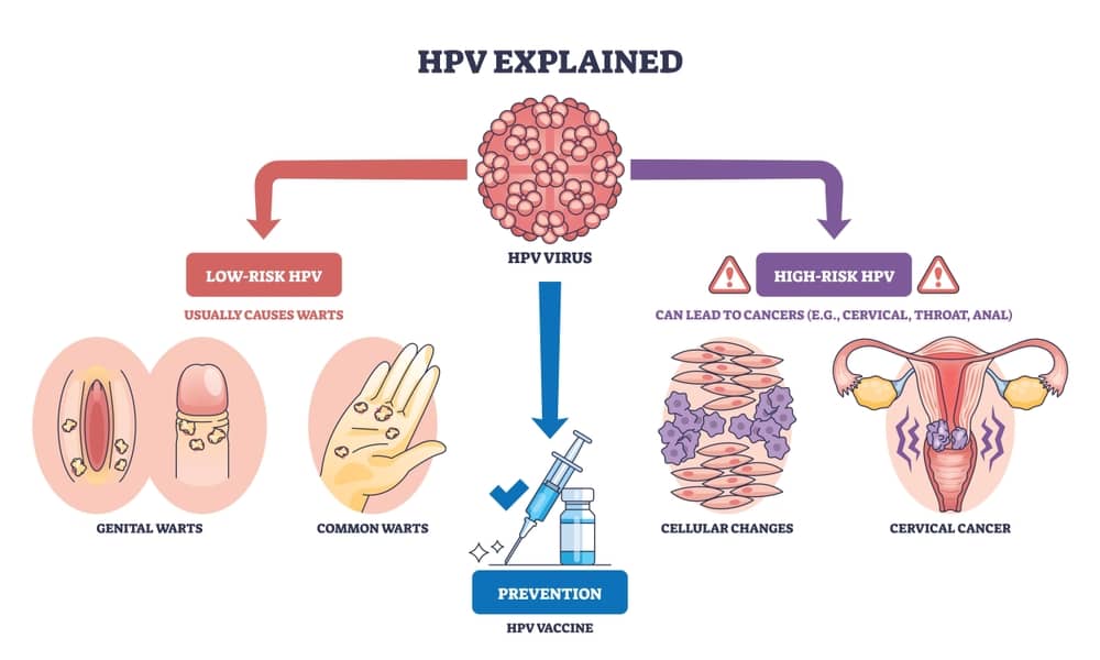 Bị nhiễm hpv type 16 phải làm gì? Nhiễm hpv 16 cần làm những gì?
