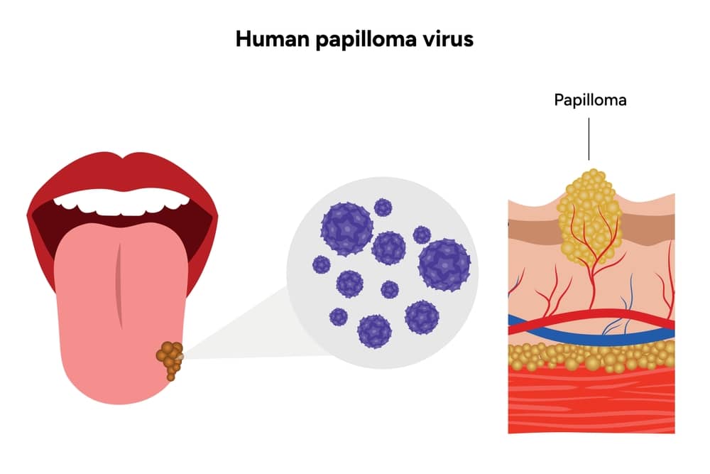 HPV lưỡi là gì