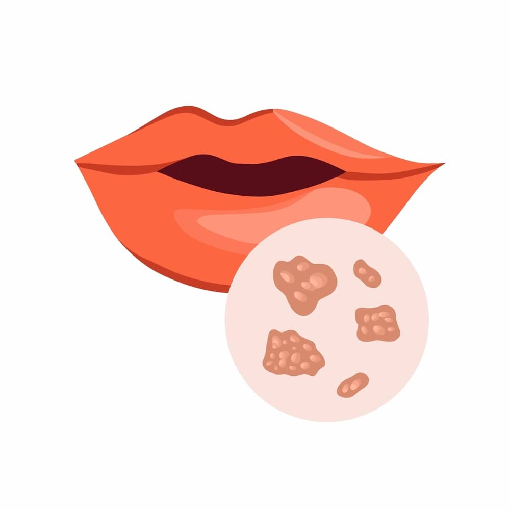HPV miệng là gì