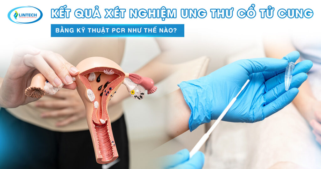 Kết quả xét nghiệm ung thư cổ tử cung