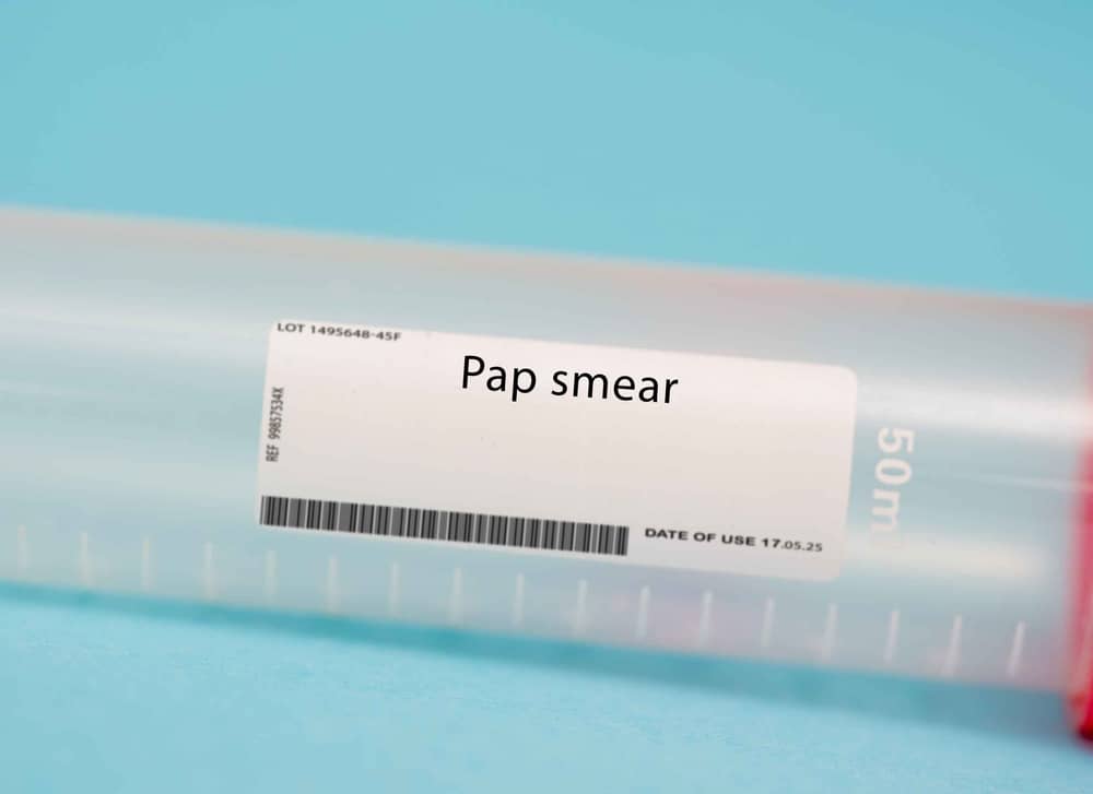 Soi cổ tử cung bằng xét nghiệm PAP Smear