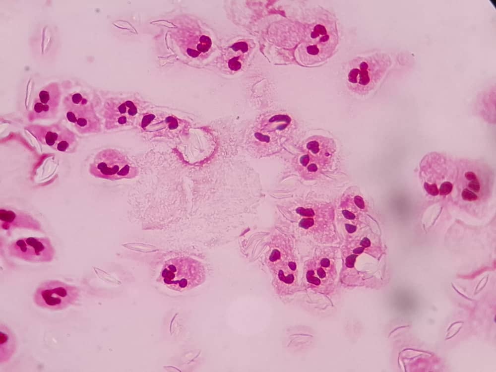 Gram stain micrograph at 1000x showing gram-negative intracellular diplococci within neutrophils on a clinical smear