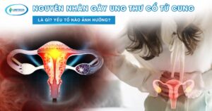 Nguyên nhân gây ung thư cổ tử cung