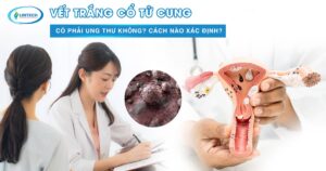Vết trắng cổ tử cung có phải ung thư không