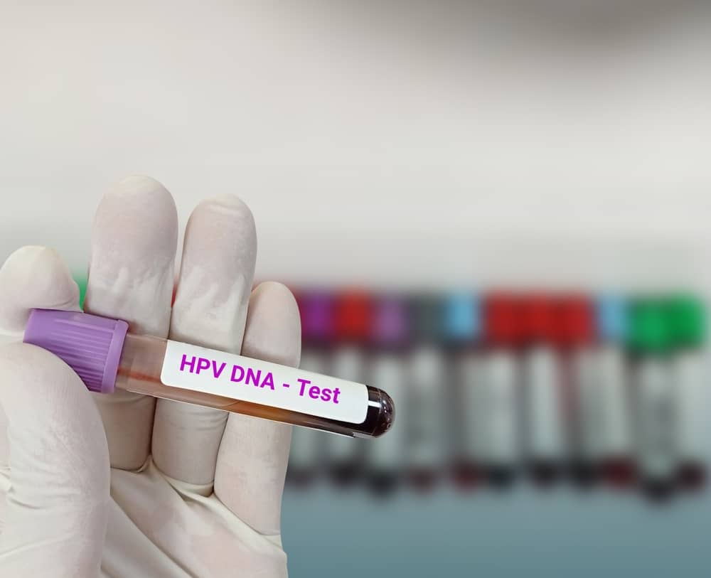 Xét nghiệm ung thư cổ tử cung bằng phương pháp HPV DNA